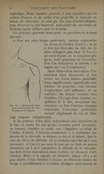 Fig. 14. - Incision de choix pour la découverte de l'articulation de l'épaule - Traitement des fract [...]