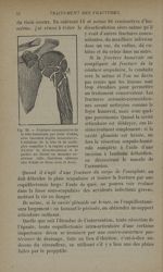 Fig. 15. - Fracture comminutive de la tête humérale par éclat d'obus, avec énormes dégâts musculaire [...]