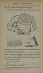 Fig. 19. - Plâtre à anse: détail de la fabrication - Traitement des fractures. T. 1 : Fractures arti [...]