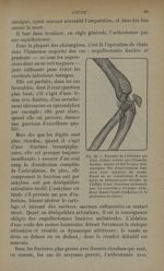 Fig. 25. - Fracture de l'olécrâne par éclat d'obus, traitée par l'immobilisation simple et des lavag [...]