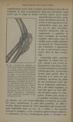 Fig. 26 - Fracture de l'olécrâne par éclat d'obus, traitée par débridement des parties molles, l'imm [...]