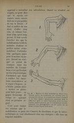 Fig. 40. - Manière de faire travailler au blessé l'extension active - Traitement des fractures. T. 1 [...]