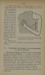 Fig. 41. - Plâtre de transport pour plaie du coude - Traitement des fractures. T. 1 : Fractures arti [...]
