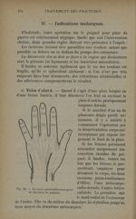 Fig. 52. - Incisions paratendineuses pour la résection du poignet - Traitement des fractures. T. 1 : [...]