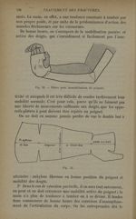 Fig. 53. - Plâtre pour immobilisation du poignet / Fig. 54 - Traitement des fractures. T. 1 : Fractu [...]