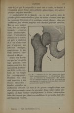 Fig. 58. - Fracture du col par contre-coup après séton transtrochantérien - Traitement des fractures [...]