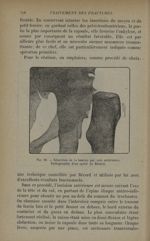 Fig. 60. - Résection de la hanche par voie antérieure - Traitement des fractures. T. 1 : Fractures a [...]