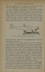 Fig. 61. - Pelvi-cervico-support d'Ollier improvisé - Traitement des fractures. T. 1 : Fractures art [...]