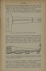 Fig. 62. - Attelle en T pour plâtre pelvi-pédieux dorsal / Fig. 63. - Plâtre pelvi-pédieux dorsal po [...]