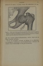 Fig. 64. - Séton cruro-fessier - Traitement des fractures. T. 1 : Fractures articulaires
