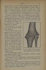 Fig. 67. - Ankylose régulière après résection typique du genou pour fracture unicondylienne - Traite [...]