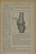 Fig. 75. - Calque radiographique montrant les insuffisances de l'arthrotomie de drainage - Traitemen [...]