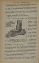 Fig. 83. - Astragalectomie primitive - Traitement des fractures. T. 1 : Fractures articulaires