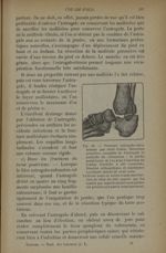 Fig. 84. - Fracture astragalo-calcanéenne - Traitement des fractures. T. 1 : Fractures articulaires
