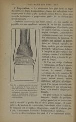 Fig. 92. - Désarticulation du pied par le procédé de Syme, sans section des malléoles - Traitement d [...]