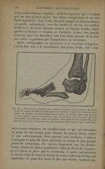 Fig. 93. - Tarsectomie subtotale pour arthrite suppurée de tout le tarse - Traitement des fractures. [...]