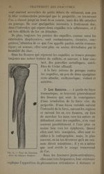 Fig. 5. - Type de fracture avec de longues fissures - Traitement des fractures. T. 2 : Fractures dia [...]