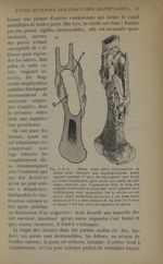 Fig. 8 et 9. - Dessin d'une pièce d'amputation de cuisse pour fracture non esquillectomisée - Traite [...]