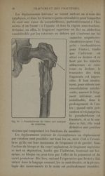 Fig. 15. - Pseudoarthrose du fémur par manque de réduction - Traitement des fractures. T. 2 : Fractu [...]
