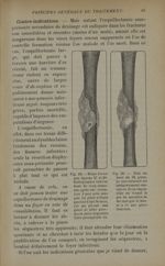 Fig. 29. - Même blessé que figures 27 et 28. Radiographie faite au bout de cinq semaines après une é [...]