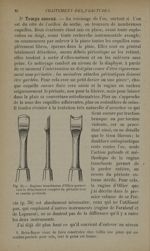 Fig. 31. - Rugines tranchantes d'Ollier permettant le détachement complet du périoste avec sa couche [...]