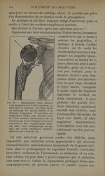 Fig. 39. - Radiographie d'une fracture sous-épiphysaire de la tête humérale - Traitement des fractur [...]