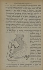 Fig. 53. - Plâtre de voyage - Traitement des fractures. T. 2 : Fractures diaphysaires