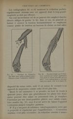 Fig. 61. - Fracture de l'humérus par balle avec orifices cutanés punctiformes avant l'extension cont [...]