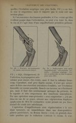Fig. 69. - Fracture sus-épiphysaire du coude, articulation intacte / Fig. 70. - Radiographie faite a [...]