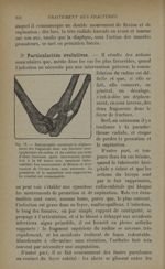 Fig. 73. - Radiographie montrant le déplacement des fragments dans une fracture sous-épiphysaire du  [...]