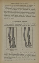 Fig. 74. - Fracture à petites esquilles / Fig. 75. - Fracture cunéenne - Traitement des fractures. T [...]