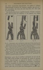 Fig. 76. - Radiographie après esquillectomie totale de fracture des deux os de l'avant-bras / Fig. 7 [...]