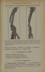 Fig. 85. - Résultat anatomique obtenu trois mois après l'esquillectomie indiquée par la figure 84 -  [...]