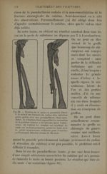 Fig. 88. - Fixation de la main en pronation forcée à la suite d'une fracture du radius avec infectio [...]