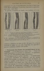Fig. 95. - Fracture du cubitus avec fissures de la diaphyse / Fig. 96. - Radiographie huit jours plu [...]