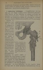 Fig. 130. - Fracture sous-trochantérienne - Traitement des fractures. T. 2 : Fractures diaphysaires