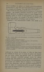 Fig. 114. - Attelle plâtrée pelvi-dorso-pédieuse, avec feuillard de renforcement (modèle de Bosquett [...]