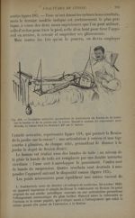 Fig. 118. - Gouttière articulée permettant le traitement en flexion de la cuisse sur le bassin et de [...]