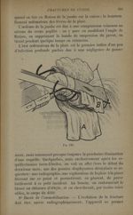 Fig. 124. - Manière de faire le pansement - Traitement des fractures. T. 2 : Fractures diaphysaires