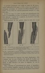Fig. 129. - Radiographie au quinzième jour après esquillectomie sous-périostée totale / Fig. 130. -  [...]