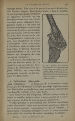 Fig. 134. - Guérison avec ankylose d'une fracture sus-condylienne - Traitement des fractures. T. 2 : [...]