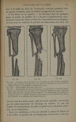 Fig. 146. - Fracture grave des deux os de la jambe / Fig. 147. - Radiographie deux mois plus tard /  [...]