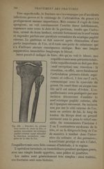 Fig. 156. - Fracture du péroné avec ostéite de toute la tête et parésie secondaire du sciatique popl [...]