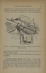 Fig. 70. - Attelle articulée de Leriche. - Détail de l'articulation - La suspension dans le traiteme [...]