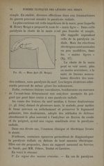 Fig. 15. - Main figée (H. Meige) - Formes cliniques des lésions des nerfs 