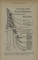 Fig. 58. - Schéma de Henry Meige - Formes cliniques des lésions des nerfs 