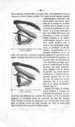 Fig. 2. Staphylôme pellucide de la cornée avant l’opération / Fig. 3. Aspect de l’oeil, vu de profil [...]