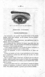 Fig. 4. — Le même oeil, vu de face, après l’opération - Bulletin de la société impériale de chirurgi [...]