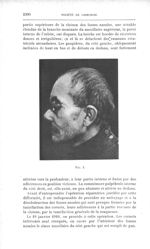 Fig. 2. [Mutilation de la racine du nez et de la paupière inférieure du côté gauche. Perte de l'oeil [...]