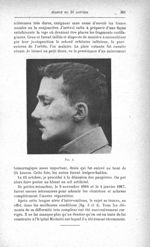 Fig. 4. [Mutilation faciale par éclat d'obus. Destruction de l'os malaire, d'une grande partie des p [...]